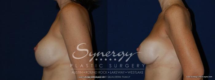 Before & After Revision Breast Augmentation Case 144 View #2 View in Austin, TX