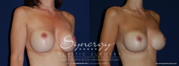 Before & After Revision Breast Augmentation Case 144 View #4 View in Austin, TX