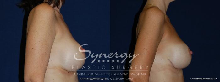 Before & After Revision Breast Augmentation Case 144 View #5 View in Austin, TX