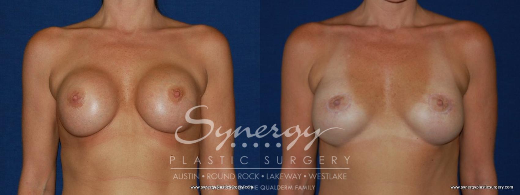 Before & After Revision Breast Augmentation Case 147 View #1 View in Austin, TX