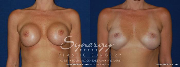 Before & After Revision Breast Augmentation Case 147 View #1 View in Austin, TX