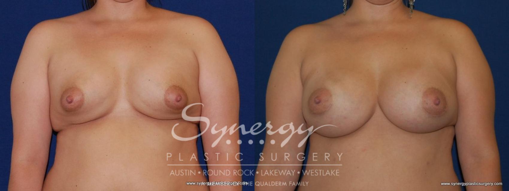 Before & After Revision Breast Augmentation Case 168 View #1 View in Austin, TX
