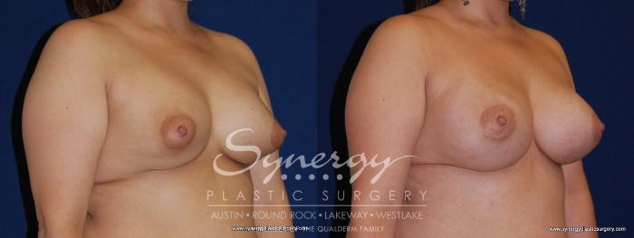Before & After Revision Breast Augmentation Case 168 View #2 View in Austin, TX