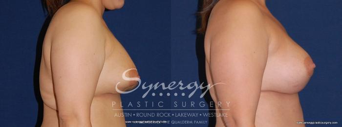 Before & After Revision Breast Augmentation Case 168 View #3 View in Austin, TX