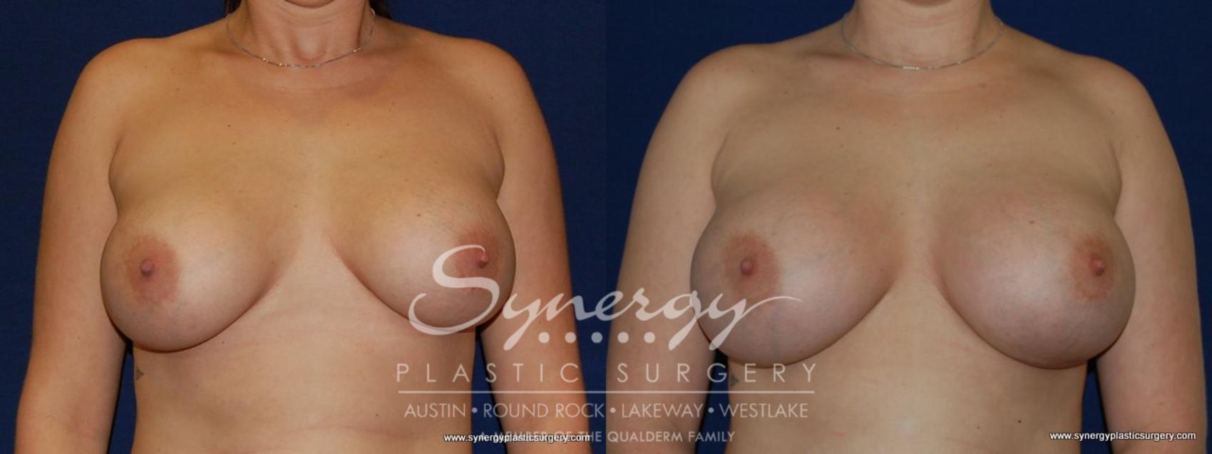 Before & After Revision Breast Augmentation Case 189 View #1 View in Austin, TX