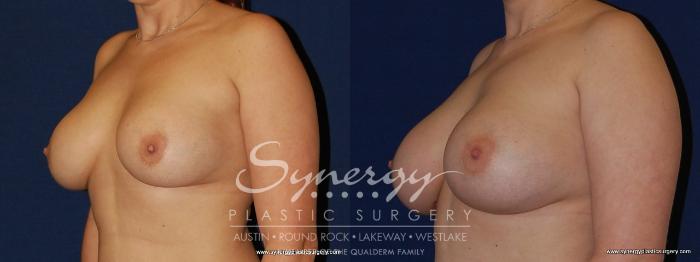 Before & After Revision Breast Augmentation Case 189 View #3 View in Austin, TX