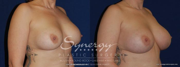 Before & After Revision Breast Augmentation Case 189 View #4 View in Austin, TX