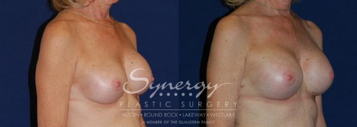 Before & After Revision Breast Augmentation Case 198 View #3 View in Austin, TX