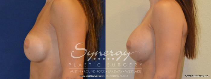 Before & After  Case 234 View #2 View in Austin, TX