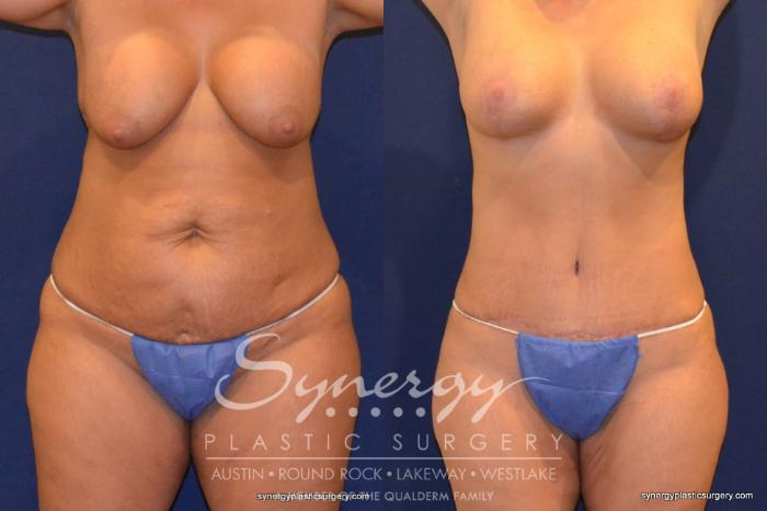 Before & After Revision Breast Augmentation Case 242 View #1 View in Austin, TX
