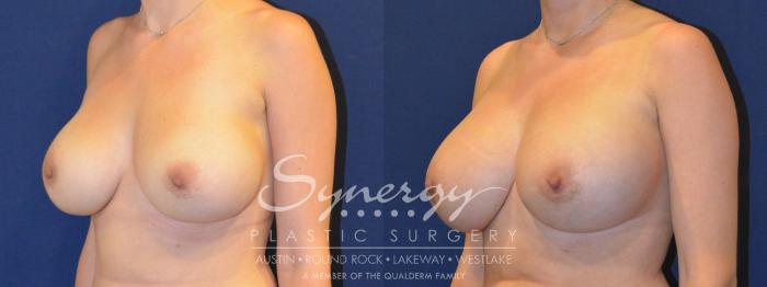 Before & After Revision Breast Augmentation Case 286 View #5 View in Austin, TX