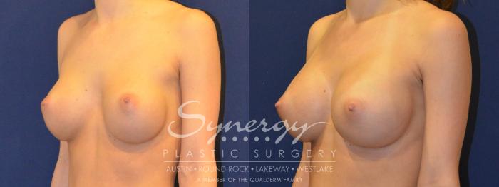 Before & After  Case 290 View #2 View in Austin, TX