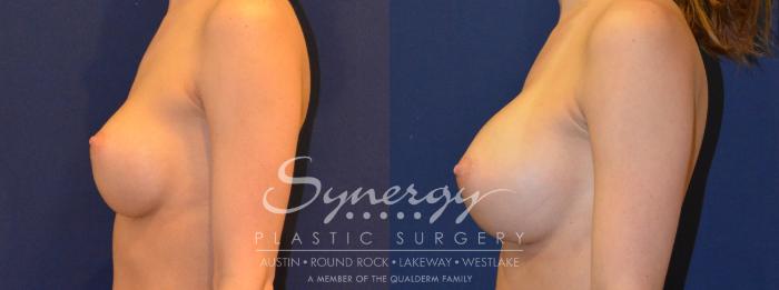 Before & After  Case 290 View #3 View in Austin, TX