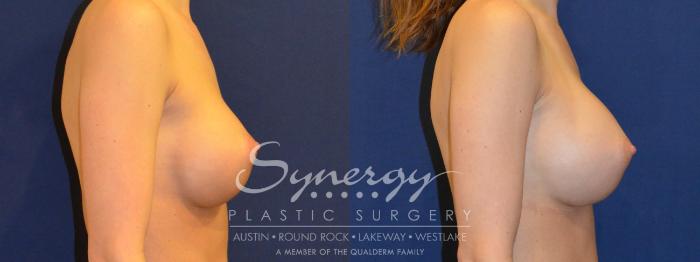 Before & After  Case 290 View #4 View in Austin, TX