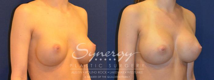 Before & After  Case 290 View #5 View in Austin, TX