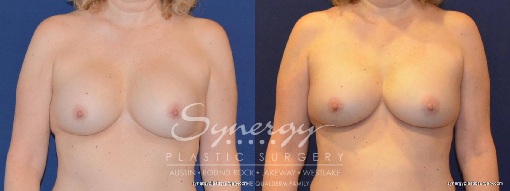 Before & After  Case 326 View #1 View in Austin, TX