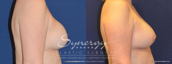 Before & After  Case 326 View #2 View in Austin, TX