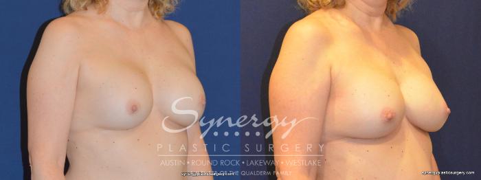 Before & After  Case 326 View #3 View in Austin, TX