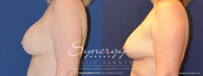 Before & After  Case 326 View #4 View in Austin, TX