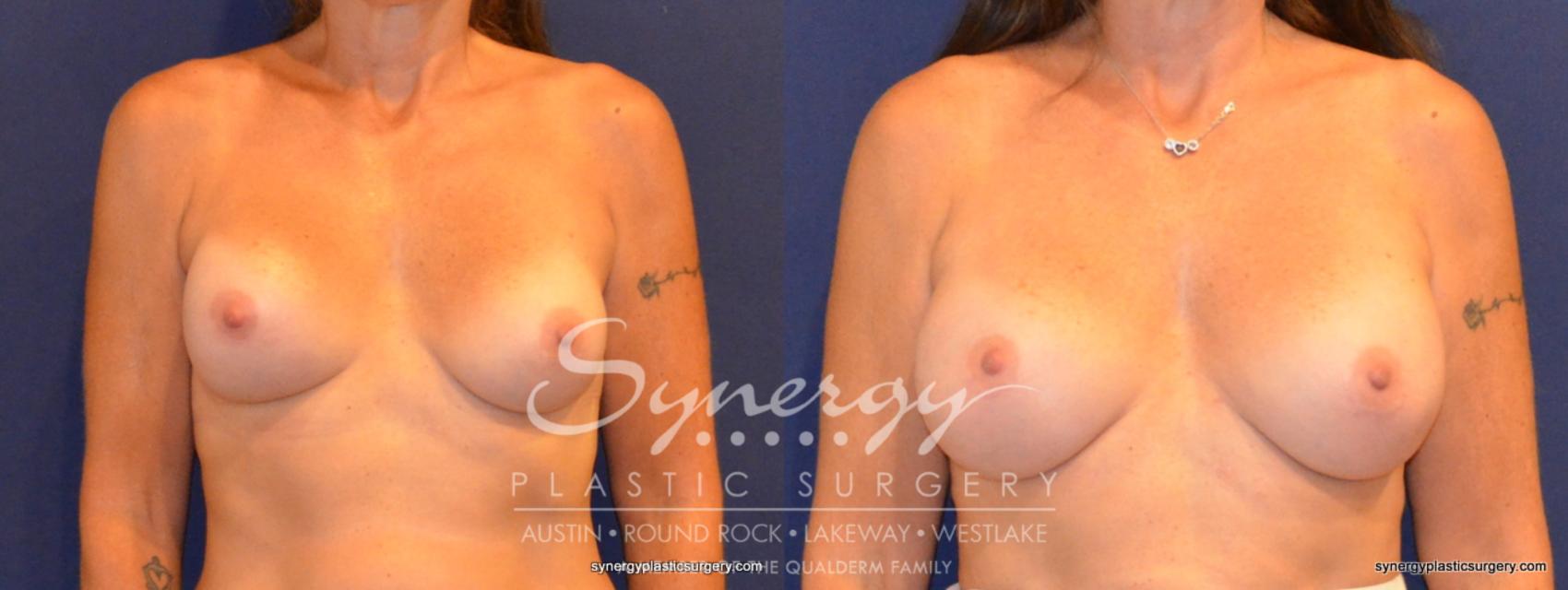Before & After Revision Breast Augmentation Case 339 View #1 View in Austin, TX