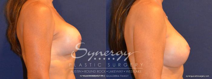 Before & After Revision Breast Augmentation Case 339 View #2 View in Austin, TX