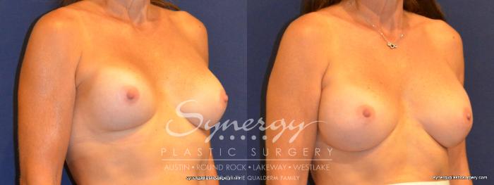 Before & After Revision Breast Augmentation Case 339 View #3 View in Austin, TX