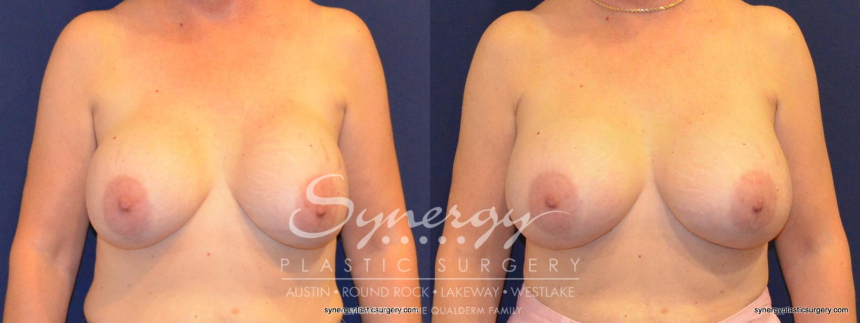 Before & After Revision Breast Augmentation Case 369 View #1 View in Austin, TX