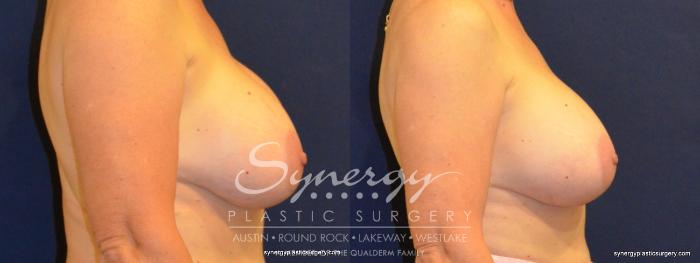 Before & After Revision Breast Augmentation Case 369 View #2 View in Austin, TX