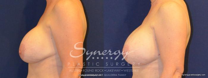 Before & After Revision Breast Augmentation Case 369 View #5 View in Austin, TX