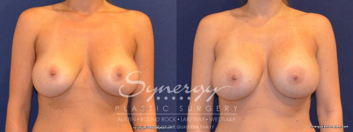 Before & After Revision Breast Augmentation Case 376 View #1 View in Austin, TX