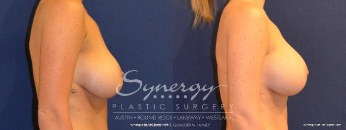 Before & After  Case 376 View #2 View in Austin, TX