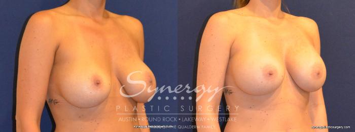 Before & After  Case 376 View #3 View in Austin, TX