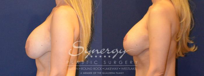 Before & After Revision Breast Augmentation Case 385 View #3 View in Austin, TX