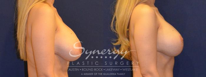 Before & After Revision Breast Augmentation Case 385 View #4 View in Austin, TX
