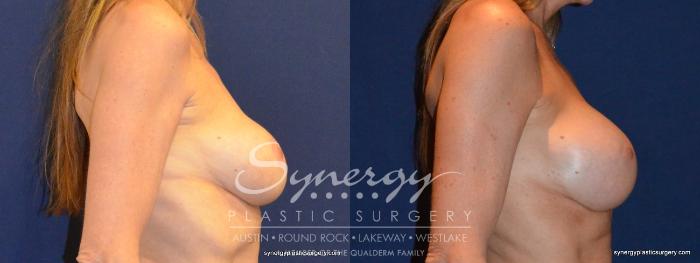 Before & After Revision Breast Augmentation Case 401 View #2 View in Austin, TX