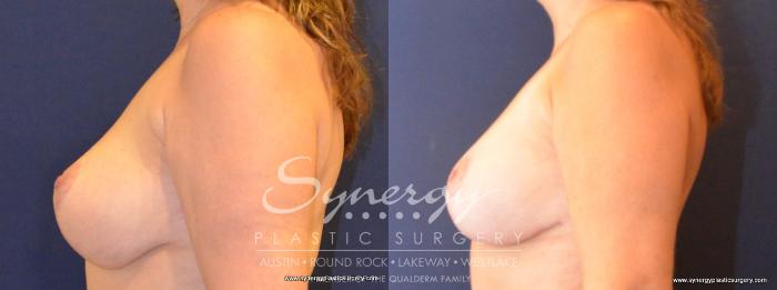 Before & After Revision Breast Augmentation Case 421 View #4 View in Austin, TX