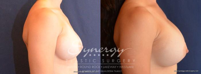 Before & After Revision Breast Augmentation Case 447 View #2 View in Austin, TX