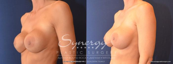 Before & After Revision Breast Augmentation Case 479 View #2 View in Austin, TX