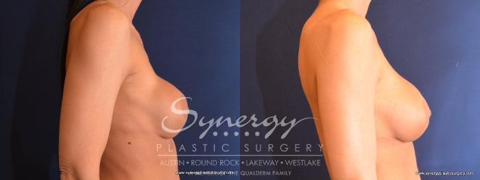 Before & After Revision Breast Augmentation Case 479 View #4 View in Austin, TX