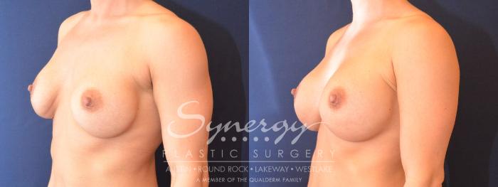 Before & After Revision Breast Augmentation Case 482 View #2 View in Austin, TX