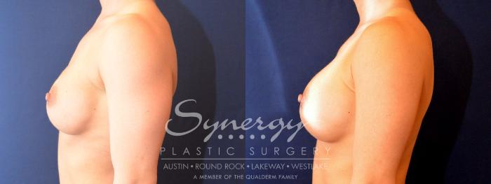 Before & After Revision Breast Augmentation Case 482 View #3 View in Austin, TX