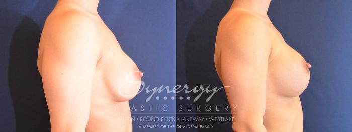 Before & After Revision Breast Augmentation Case 482 View #5 View in Austin, TX