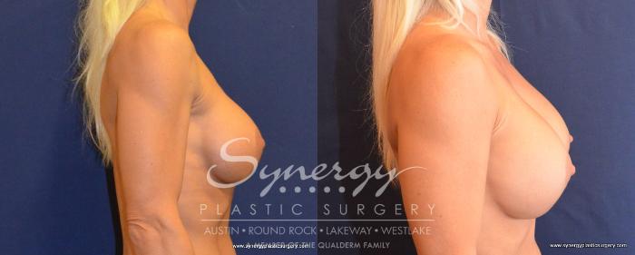 Before & After  Case 493 View #2 View in Austin, TX