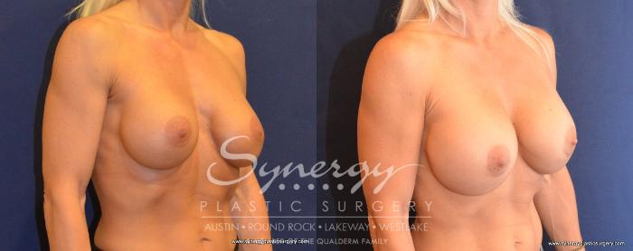 Before & After  Case 493 View #4 View in Austin, TX