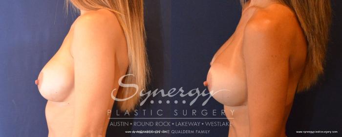 Before & After Revision Breast Augmentation Case 495 View #3 View in Austin, TX