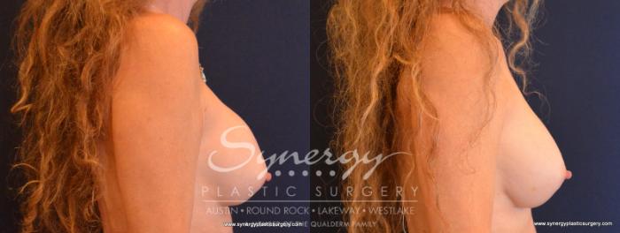 Before & After Revision Breast Augmentation Case 558 View #5 View in Austin, TX