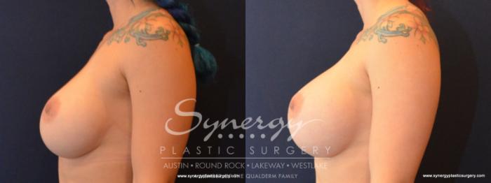Before & After Revision Breast Augmentation Case 565 View #3 View in Austin, TX