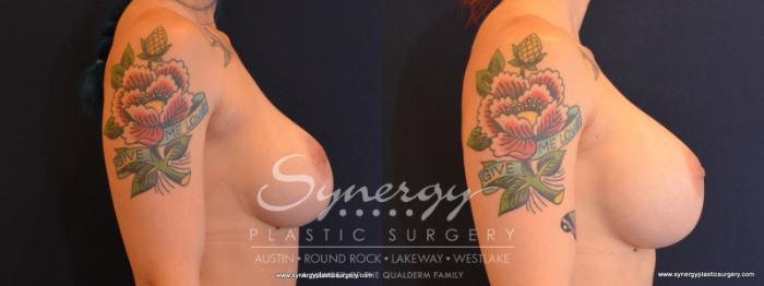 Before & After Revision Breast Augmentation Case 565 View #5 View in Austin, TX