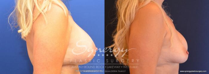 Before & After Revision Breast Augmentation Case 577 View #3 View in Austin, TX
