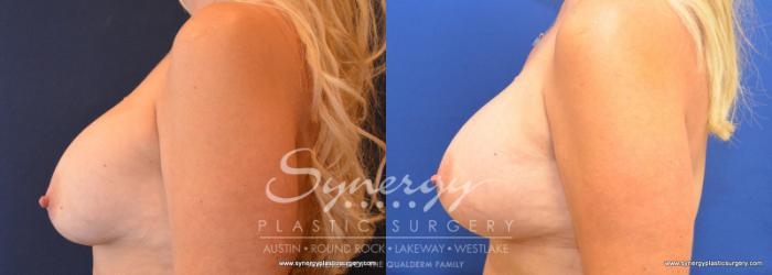 Before & After Revision Breast Augmentation Case 577 View #4 View in Austin, TX